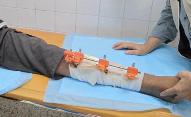 加沙医生在资源匮乏地带利用3D打印造出“救命”外固定器 image