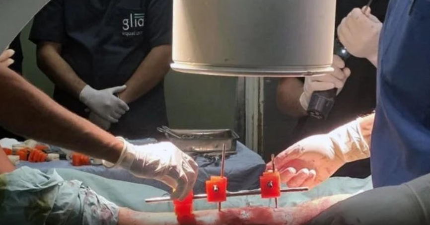 加沙医生在资源匮乏地带利用3D打印造出“救命”外固定器 image