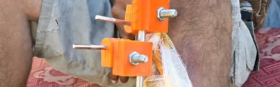 加沙医生在资源匮乏地带利用3D打印造出“救命”外固定器 image