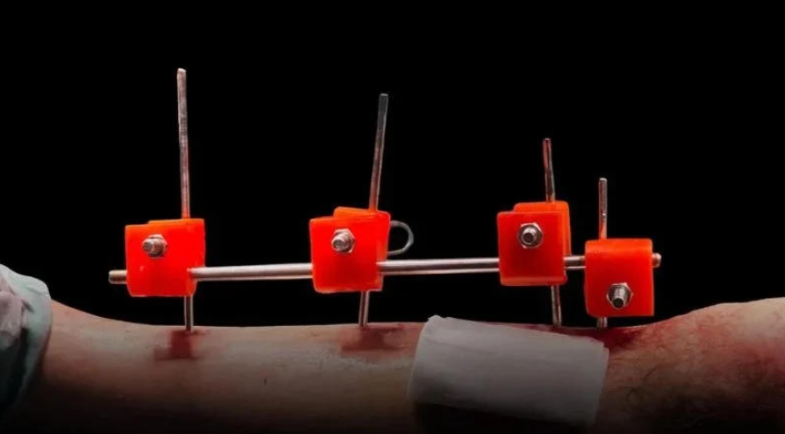 加沙医生在资源匮乏地带利用3D打印造出“救命”外固定器 image