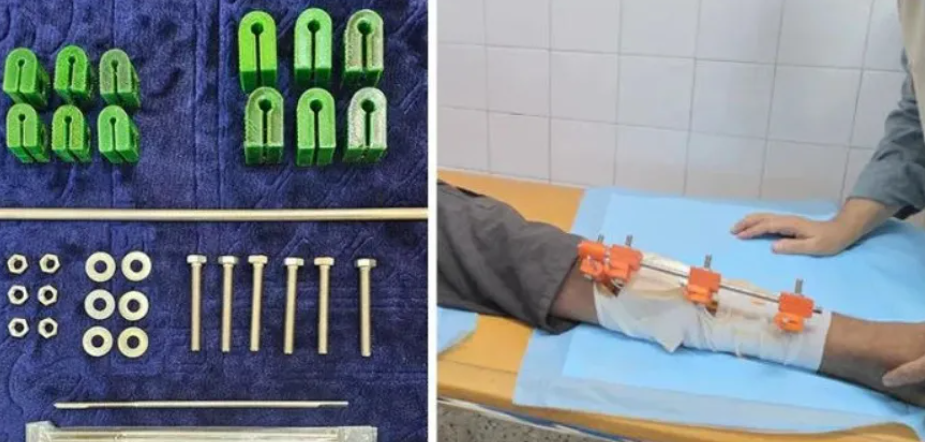 加沙医生在资源匮乏地带利用3D打印造出“救命”外固定器 image